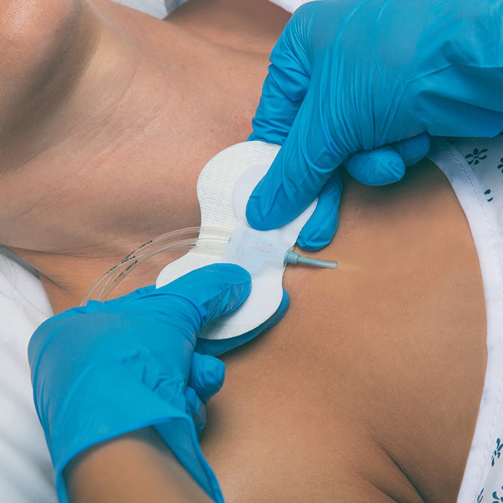 Grip-Lok Securement Devices: Optimized for Patient Comfort and Safety